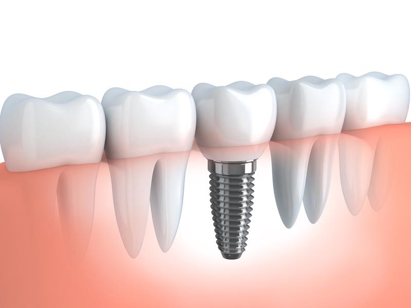 Dental Implants  Reynoldsburg, OH 
